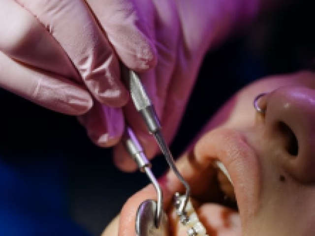 Why Adults Are Choosing Clear Aligners Over Traditional Braces