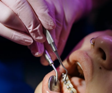 Dentist adjusting braces on a patient’s teeth for orthodontic alignment.