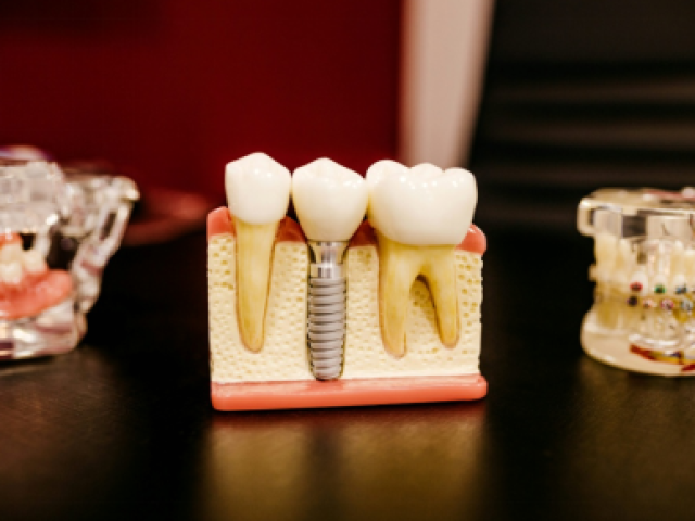 Why Dental Implants Are Considered the Closest Replacement to Natural Teeth