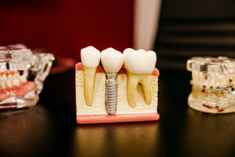 Dental implant model showing the implant post, abutment, and crown used to replace a missing tooth.
