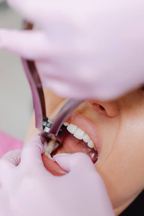 a patient getting a tooth extracted.